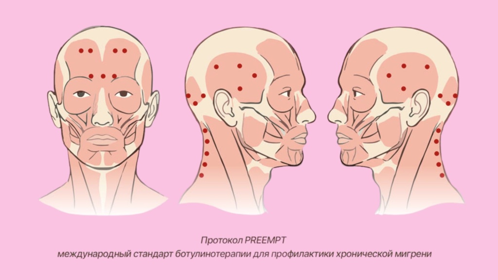 Протокол PREEMPT предусматривает введение ботулотоксина в строго определённые анатомические точки в области головы и шеи. Протокол PREEMPT предусматривает введение ботулотоксина в строго определённые анатомические точки в области головы и шеи.